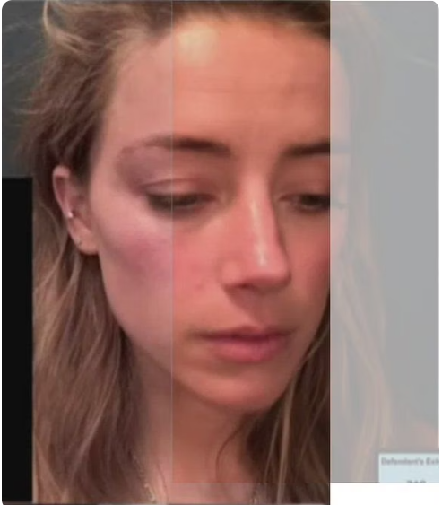 Amber Heard's injury photos